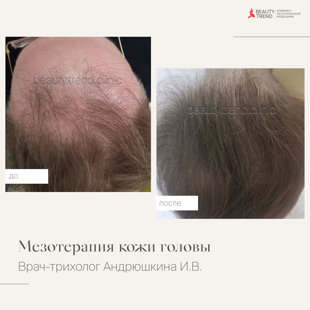 Мезотерапия для укрепления волос, 2А - 1